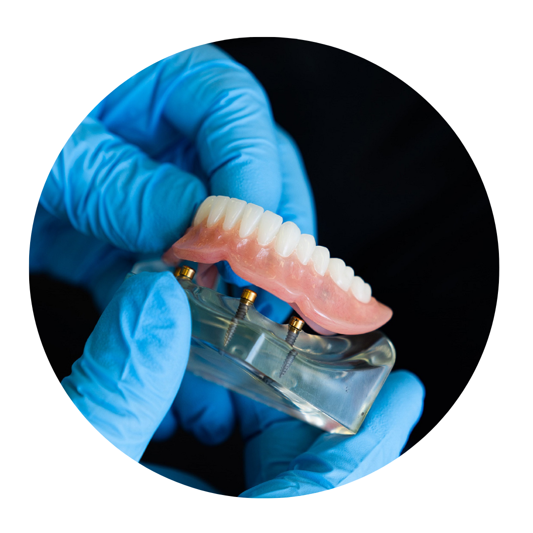 Protocolo Sobre Implante