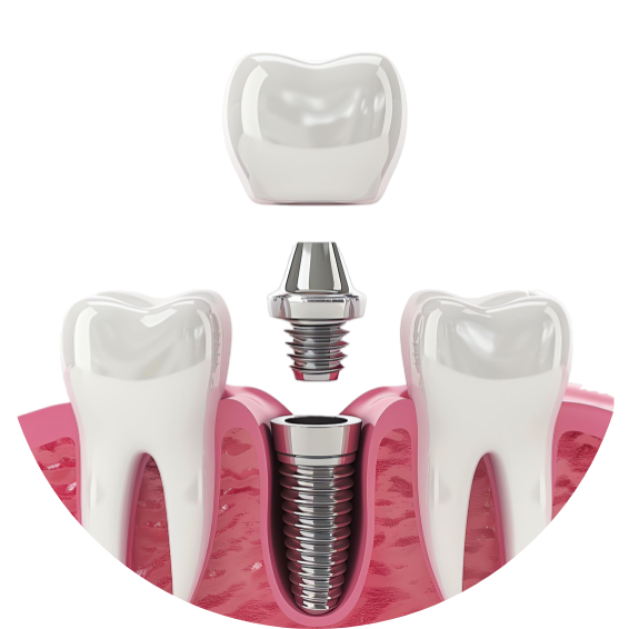 Implantes Unitários